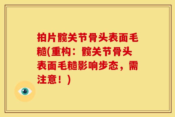 拍片髋关节骨头表面毛糙(重构：髋关节骨头表面毛糙影响步态，需注意！)