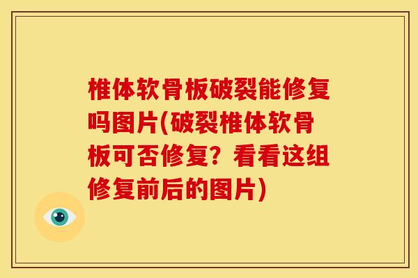 椎体软骨板破裂能修复吗图片(破裂椎体软骨板可否修复？看看这组修复前后的图片)